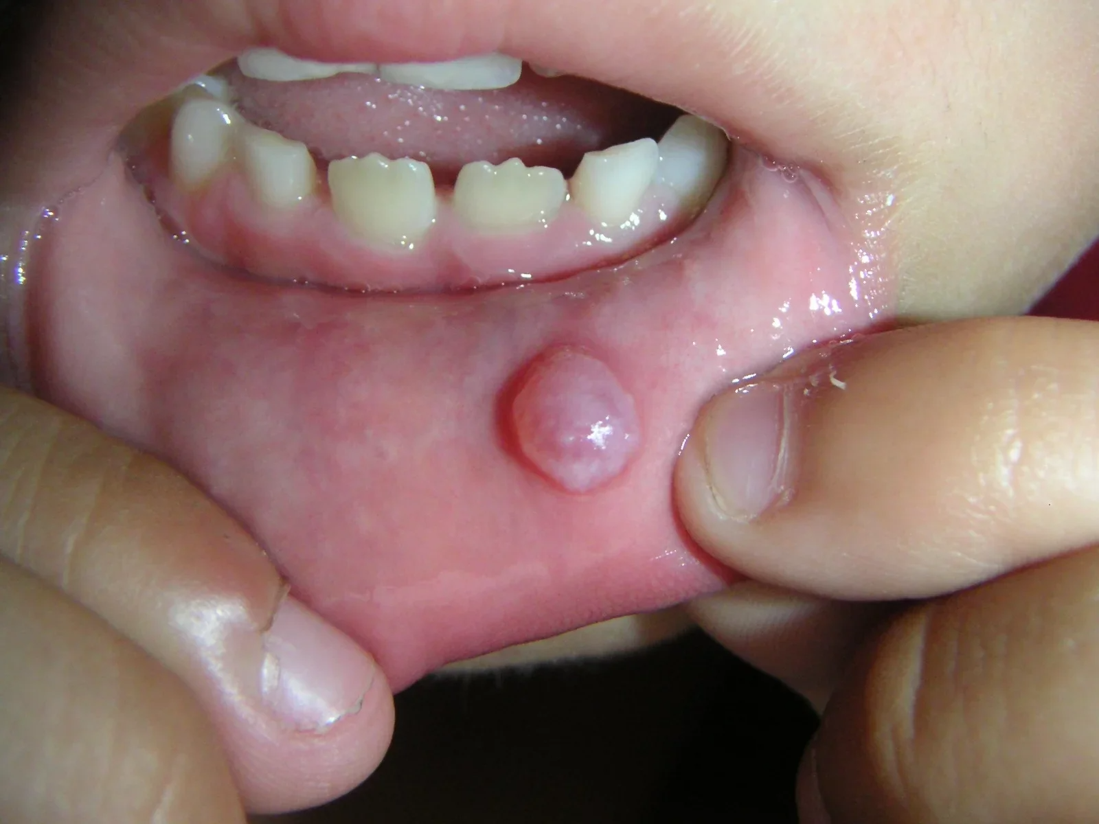 Mucocele, Oral Mucocele Symptoms & Treatment in Thane