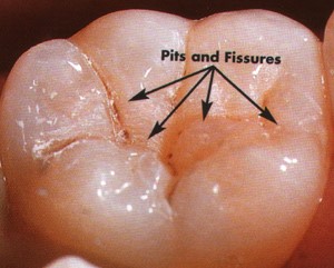 Pit and fissure sealant treatment for preventing cavities