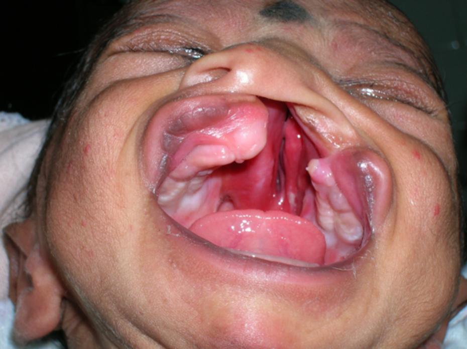 Cleft Lip and Palate Treatment In Thane