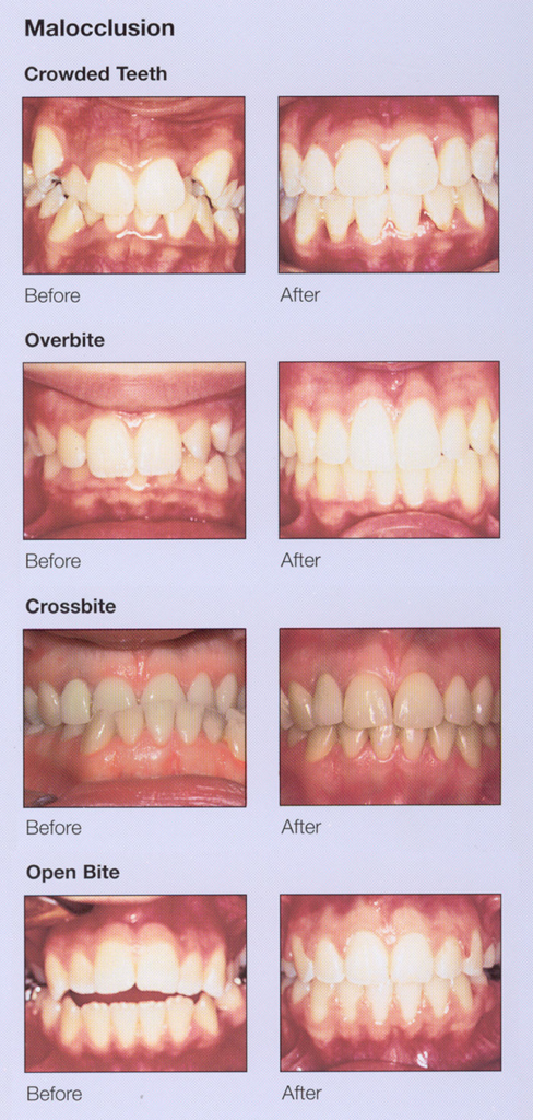 Dental braces and teeth alignment treatment