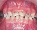 Baby bottle tooth decay symptoms