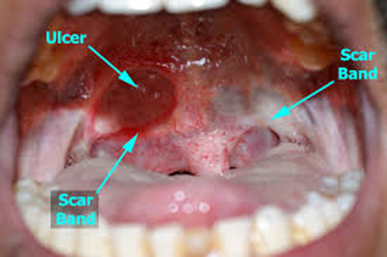 Leukoplakia white patches inside mouth