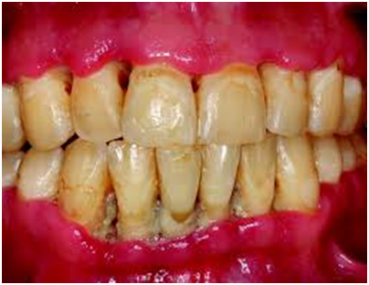 Oral candidiasis infection in HIV patient