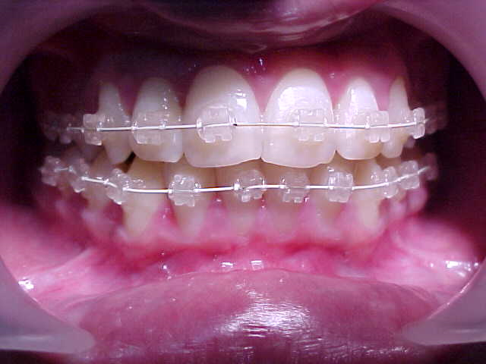 Patient wearing dental braces during orthodontic treatment