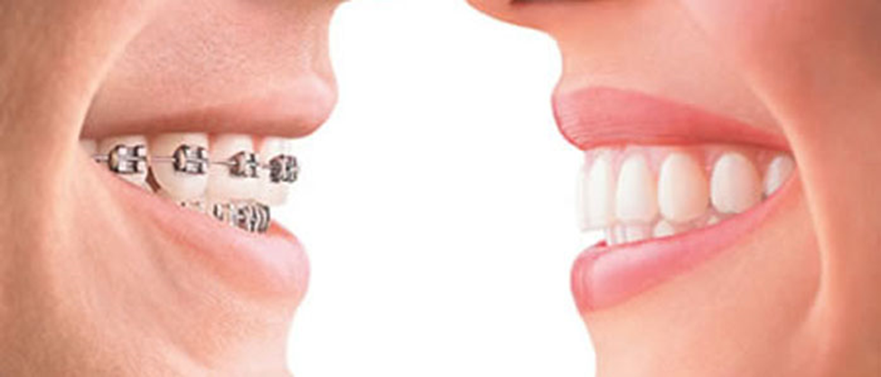 Orthodontic Treatment in Thane: Braces, Benefits, Procedure and Precautions