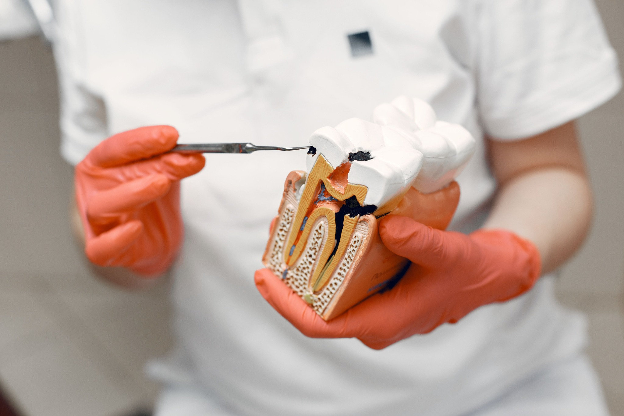 Illustration explaining root canal treatment and infected tooth pulp